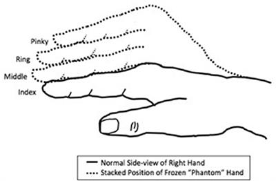 Phantom Sensations Following Brachial Plexus Nerve Block: A Case Report